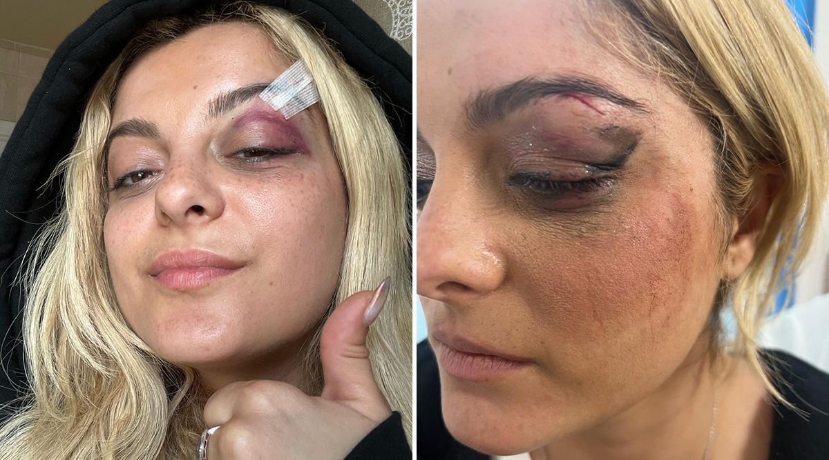 CRUELTY: Bebe Rexha Rushed Off Stage After Person Throws Phone On Her Face; Succumbs To BRUSIES! (Details Inside)