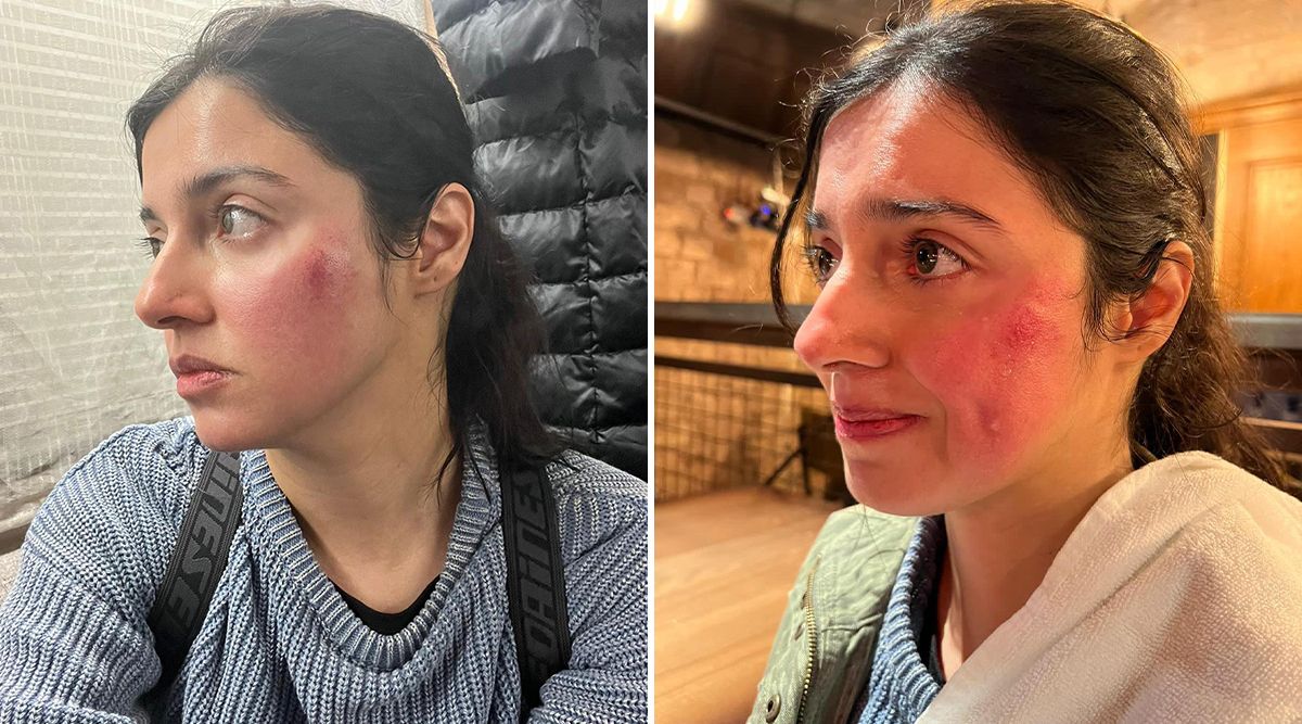 Oh No! Divya Khosla Kumar "Badly injured" Her Face While Filming, Shares Photo On Instagram