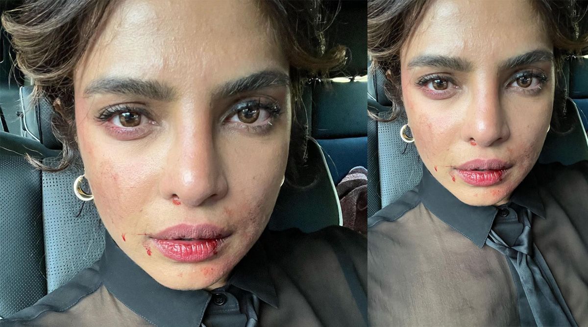 Priyanka Chopra shares a photo of her bruised face from the set of Citadel leaving fans concerned