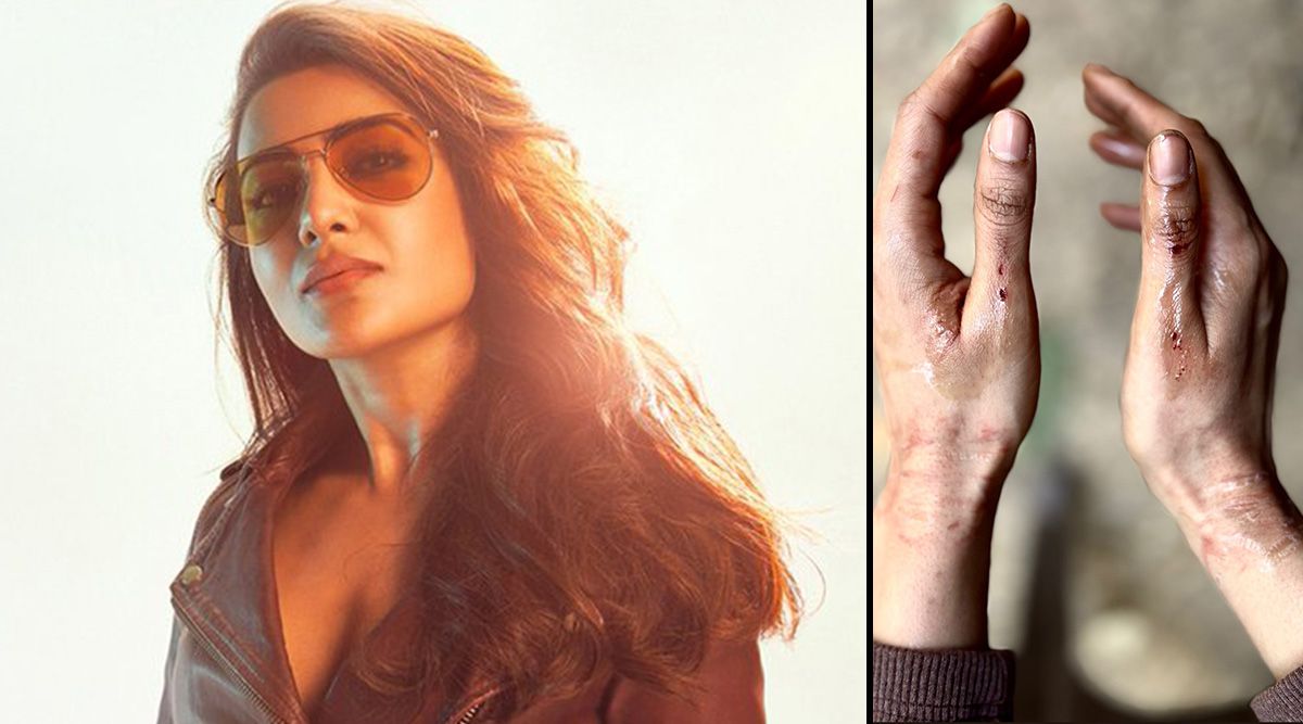Samantha Ruth Prabhu SHARES a picture of wounded hands as she injures herself on the sets of Citadel; Check out!